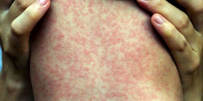 Ministério da Saúde confirma 1.226 casos de sarampo no Brasil