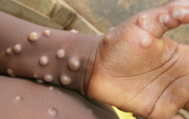 OMS declara varíola dos macacos como emergência de saúde global